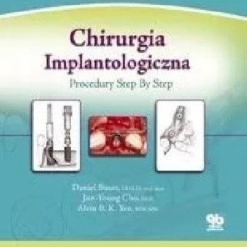 Chirurgia Implantologiczna: Procedury Step by Step