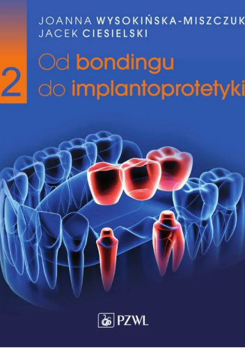 Od bondingu do implantoprotetyki. Część 2