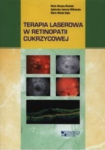 Terapia laserowa w retinopatii cukrzycowej